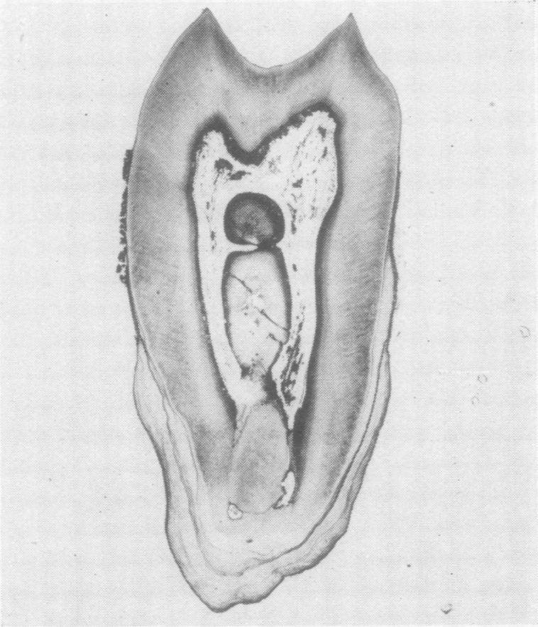 D, dentine; C, cementum; P, periodontal membrane; A, alveolar bone, x 50. FIG. 4.-Apex of tooth shown in Fig.