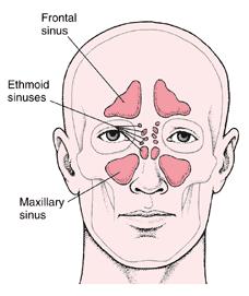 ETHMOID - continued Ethmoid sinuses associated