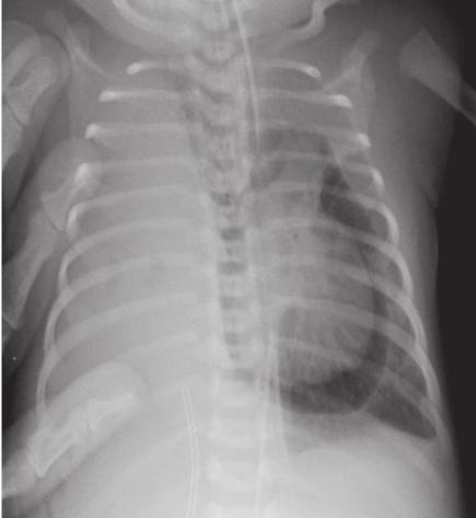 REPORT A five-day old girl presented with a pneumopericardium discovered fortuitously on a radiograph (Figure 1).