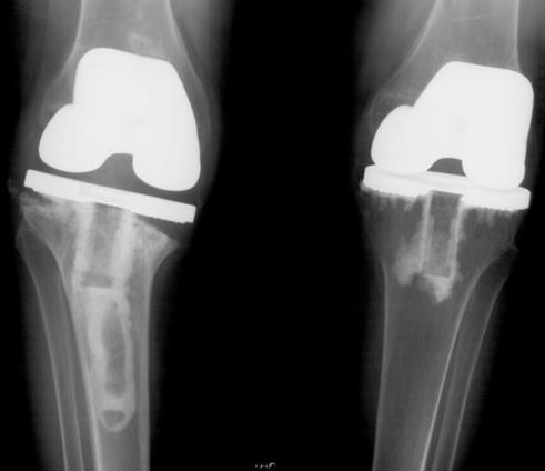 Aseptic loosening: etiologies True long-term aseptic loosening is multifactorial (prosthetic malalignment, implant factors, osteolysis) Recent multicenter study estimated aseptic loosening to cause