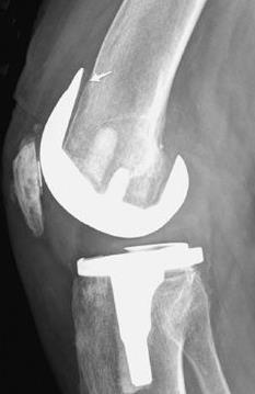 Aseptic loosening : femoral component Uncommon when compared to tibial loosening 1 Estimated incidence at 1.