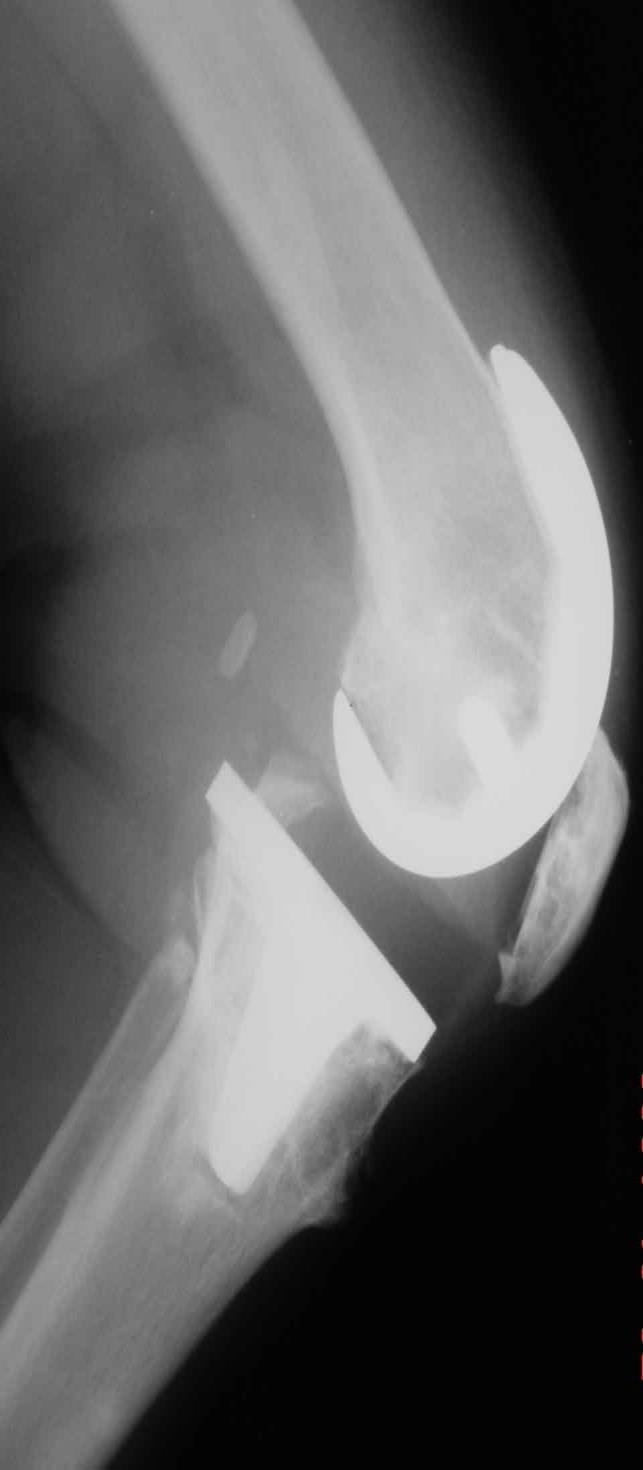(3) Collier MB, Engh CA, McCauley JP, et al: Osteolysis after total knee arthroplasty: influence of tibial baseplate surface finish and sterilization of polyethylene insert.