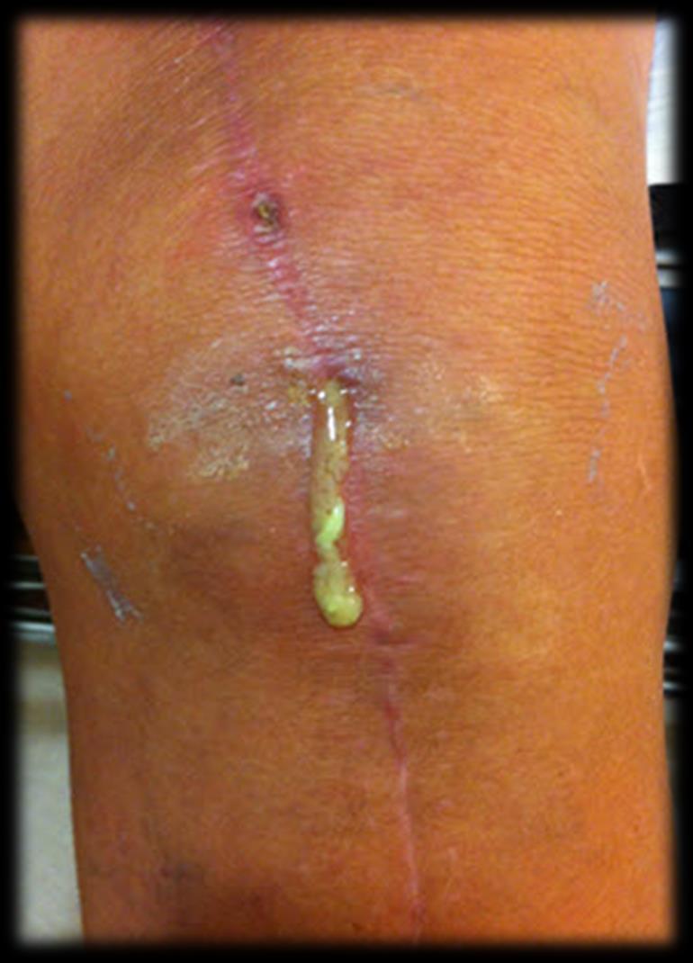 Periprosthetic late infection Infection is less likely a cause of failure beyond two years Most studies reported on infection as the leading cause of failure in the first two years from the index