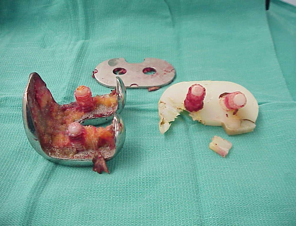 Rarely occur before10 to15 years from index surgery; more predominant after 15 years Other causes: instability,