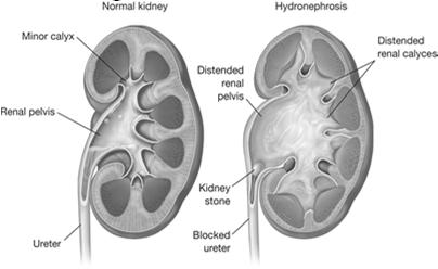 Hydronephrosis Hydronephrosis Treatment vesico-ureteral reflux obstructing stones obstructing tumors ureteral stricture, scarring, or external compression Decrease bladder pressures (increase CIC