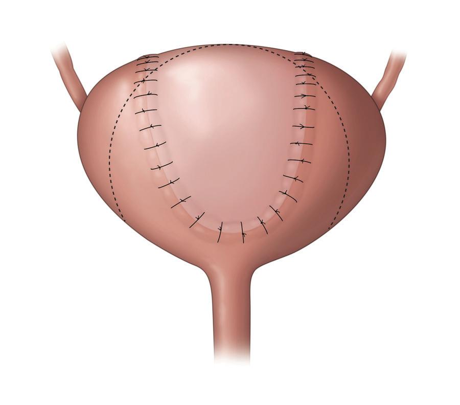 Bladder surgery In case your symptoms have not improved with drug or other treatments, you may need surgery on your. The goal of the procedure is to increase the capacity of the.