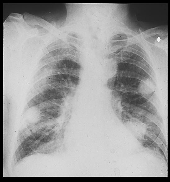 RHEUMATOID ARTHRITIS Rheumatoid nodules Lung Caplan s syndrome Lung Fibrosis
