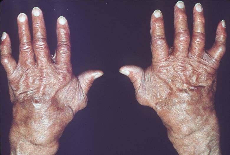 Chronic systemic inflammatory disease of undetermined etiology involving primarily the synovial membranes and articular structures of multiple joints.
