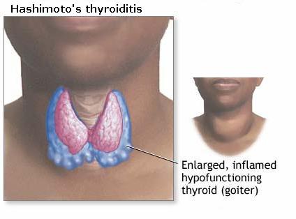 Hashimoto s thyroiditis, Autoimmune Anemias, Goodpasture s syndrome and Insulin Dependent Diabetes Mellitus (IDDM) to name a few.