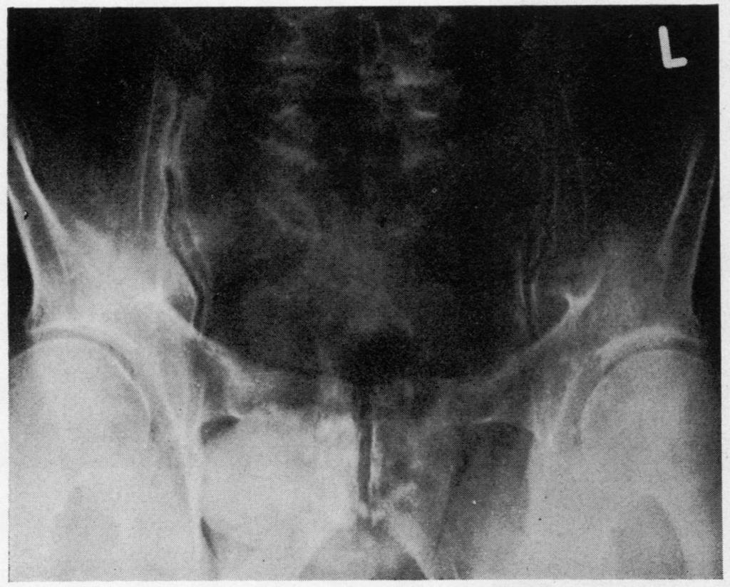 were discordant for ankylosing spondylitis. Three further concordant pairs of monozygotic twins have since been reported (Kuthan and Navratil, 1966; Truog et al., 1975).