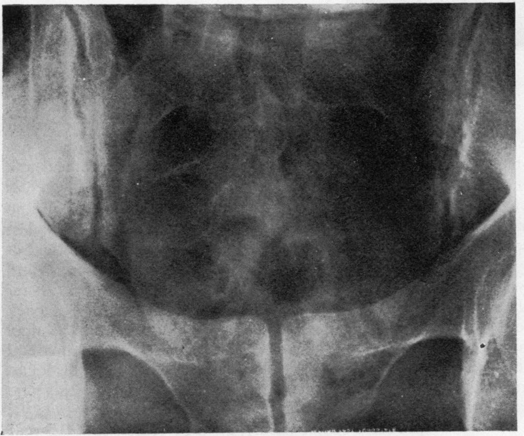 Patients and methods Each twin had a full history and rheumatological Discordance for ankylosing spondylitis in monozygotic twins 361 examination and radiographs of the sacroiliac joints were