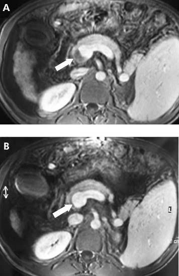 694 Francoz, Belghiti, Vilgrain, et al Figure 1 (A, B) Post contrast magnetic resonance imaging showing a partially obstructive thrombus at the junction of the splenic and mesenteric veins (A, white
