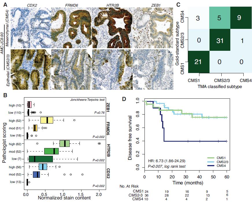 Immunohistochemical subtyping of colorectal cancer Institut für Pathologie Classification into 4 subtypes is done with MSI-analyses + 5 immunohistochemical markers (CDX2 for epithelial; FRMD6, HTR2B,