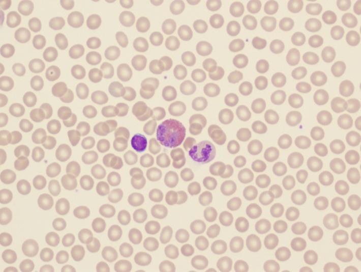 Blood Cell Morphology 1. Microcytic, hypochromic anemia MCV < 80 MCH < 27 MCHC < 32 2.