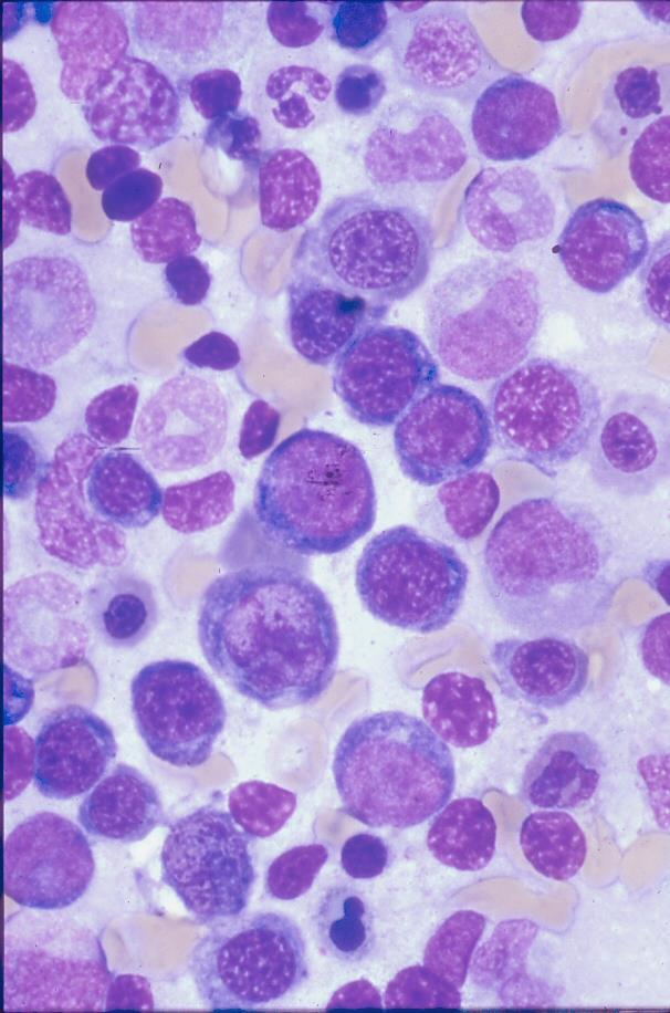 Megaloblastic Anemia: Bone Marrow Megaloblastic Erythropoiesis characterized