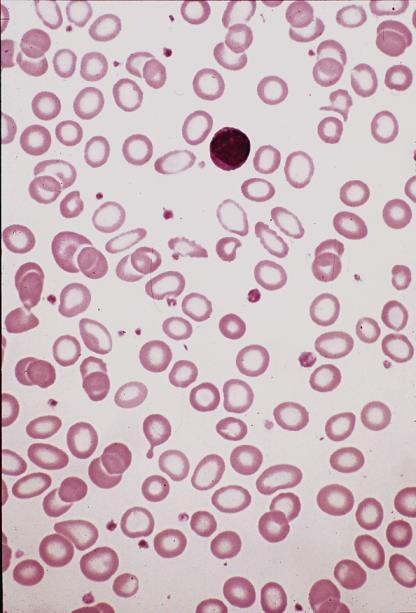 metamyelocytes Hypochromic Microcytic Anemia The peripheral smear shows: