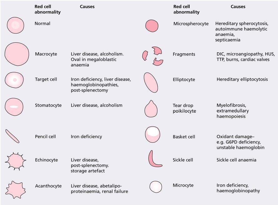 Classification of Hemolytic Anemias Intracellular Causes Red cell membrane defects Enzyme defects Hemoglobin defects Thalassemia Sickle cell disease Hemoglobin C Extracellular causes Autoimmune