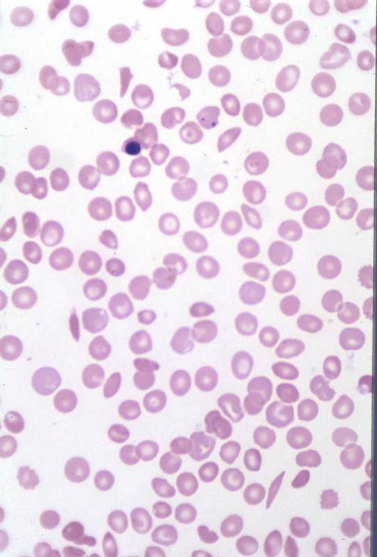 Hemoglobin Defects: Sickle Cell Disease Target Cell