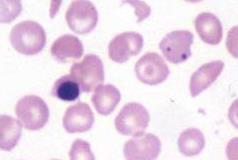 Howell-Jolly Sickle cell Target Cell Howell-Jolly bodies