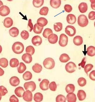 nucleated red cells (normoblasts).