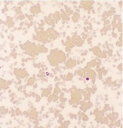 Causes of Hemolysis: Microangiopathic Blood film in microangiopathic hemolytic anemia.