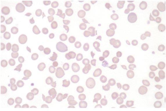 of immunoglobulins (Ig)/or complement on the red blood cell surface (direct) or the presence of anti red blood cell Ig in the serum (indirect) Direct Coombs The patient
