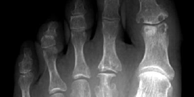DMARD cannot stop progress of joint destruction in RA patients with stage I: radiographic changes after 2-year treatment Ⅰ