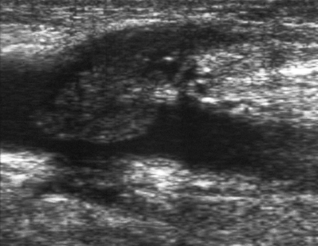 Acute Venous Thrombosis Soft, deformable with compression
