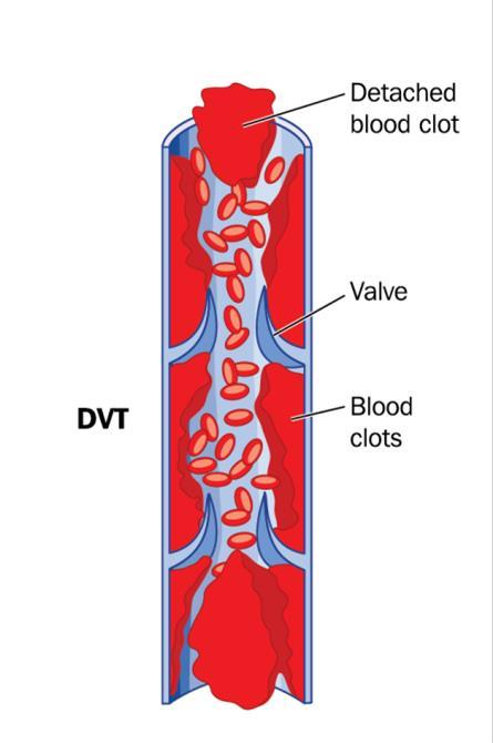 Diagnosing DVT The Challenge - Approximately half of patients with DVT are asymptomatic.