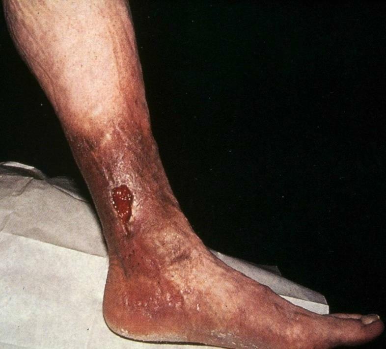 Post-thrombotic Syndrome (PTS) Chronic pain, edema and fatigue of affected limb after DVT Severe PTS may result in venous claudication, stasis dermatitis, subdermal fibrosis and ulceration -> tissue