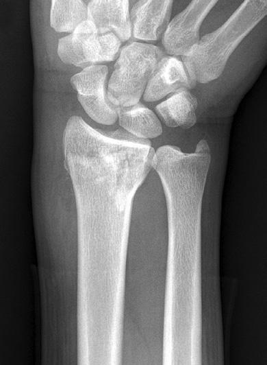 Simultaneously, he also sustained a contralateral unstable fracture of distal radius.