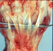 tension on the portion of the tendon distal to the repair.