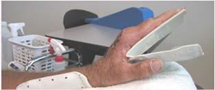 & M, 40 in R & Controlled Early Active Motion Splint position Wrist held in 20 ext, MPs/IPs at 0 MP moves
