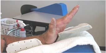 yoke orthosis with the involved MP in 15-20 greater extension relative to uninvolved joints.