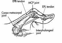 Deformity of the Thumb Pathology begins at MP