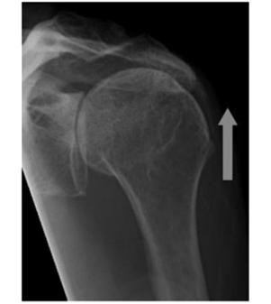 Complete Rotator Cuff Tear Complete tears will often retract and scar down, making surgical repair difficult if delayed More common in adults > 40 years old Often diagnosed as tendonitis Obvious