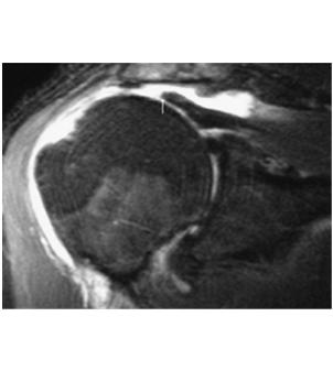 osteoarthritis Slipped capital femoral epiphysis (SCFE) Femoral head slips inferior and posterior to femoral neck Incidence 2/100,000 children; may be bilateral (20-40%) More common in boys (mean age