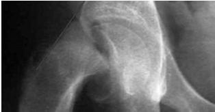years old Often painless, but will develop limp; easily diagnosed on x-ray Goal of