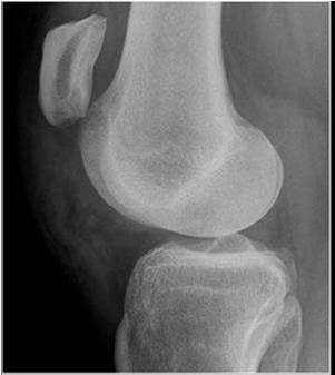 Patellar/Quad Tendon Rupture Most common in 3 rd & 4 th decades of life Increased