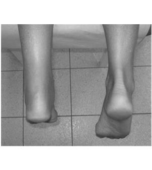 Palpable defect Swelling/ecchymosis possible Positive Thompson s test Imaging studies obtained to r/o avulsion fracture Diagnosis Thompson Test Treatment Casting vs.