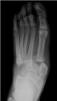 suspicious Refer to Ortho foot/ankle