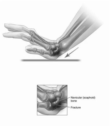 Scaphoid fractures Most commonly fractured carpal bone MOI: FOOSH injury (also