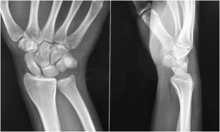 Normal radiographs Radiographs PA, lateral, oblique (standard) and scaphoid views Negative initial x-ray doesn t rule out a fx Rule of thumb: if positive hx/moi and