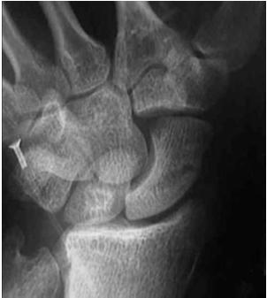 immobilized in short arm thumb spica cast Distal 1/3 fxs 4-6 weeks Middle 1/3 and waist fxs 10-12 weeks (may change to short arm thumb spica cast after 6 weeks) Proximal