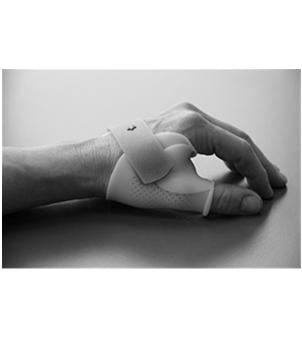 present, thumb spica splint for 4-6 weeks If Stener lesion is present,
