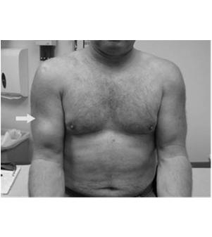 Deformity presents after several weeks Usually requires surgery Biceps Tendon Rupture 90+% are