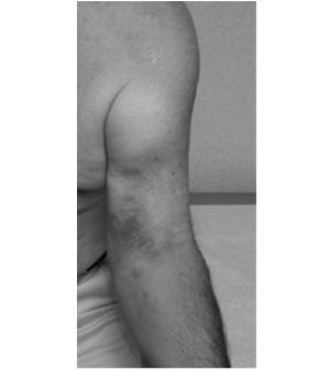 significant loss of supination strength Usually acute injury DDx: anterior capsule strain,