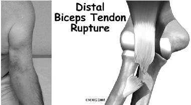 Distal biceps rupture attaches to radial tuberosity primary function: