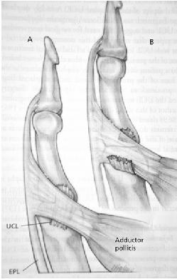 Thumb Ulnar Colateral Ligament 23 Thumb UCL gamekeepers thumb skier s thumb UCL ruptures and retracts behind