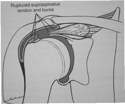 Rotator Cuff Supraspinatus, infraspinatus, teres minor, subscapularis stabilizes head in glenoid abducts, externally and internally